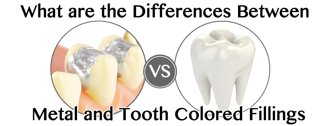 Apr-Anglis-Fillings-header