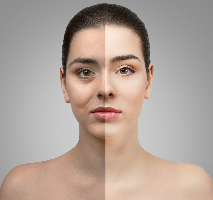 Lower Eyelid Surgery