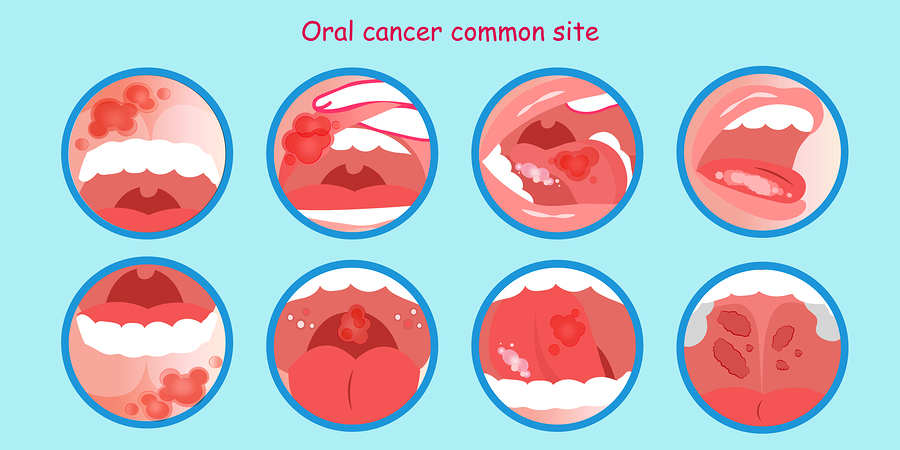 Oral Cancer