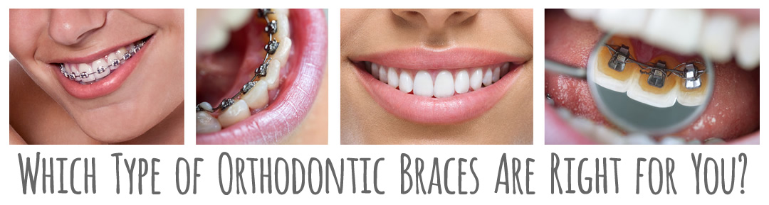 Orthodontic Braces